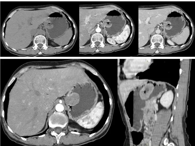 Гастроинтестинальная стромальная опухоль кт. Гастроинтестинальная стромальная опухоль желудка на кт. Стромальная опухоль желудка на кт. Гастроинтестинальная опухоль