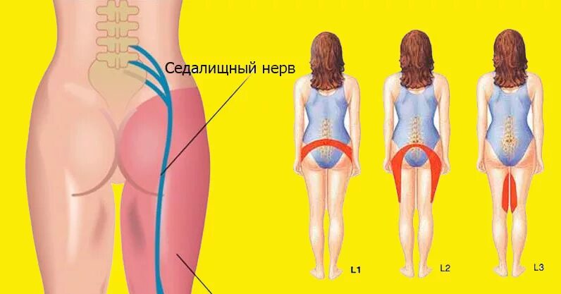 Упражнения для седалищного нерва. Упражнения при защемлении седалищного нерва. Упражнение для поясницы и седалищного нерва.