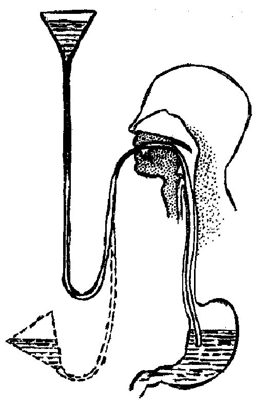 Промывание желудка через зонд. Технология промывания желудка толстым зондом. Зондовое промывание желудка схема. Объем воронки, используемой для промывания желудка. Желудочный зонд для промывания желудка техника.