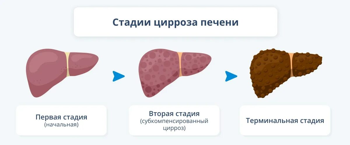 Ранние стадии печени. Бессимптомный цирроз печени. Цирроз печени стадии развития.