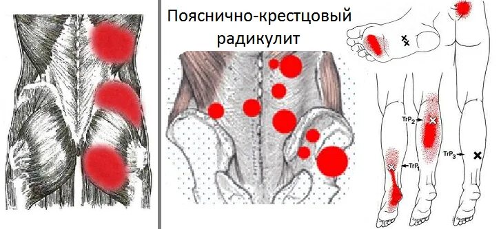 Радикулит поясница. Клинический симптом пояснично-крестцового радикулита. Боль в спине триггерные точки. Триггерные точки поясницы и ягодиц. Клинический симптом пояснично-крестцовой радикулопатии.