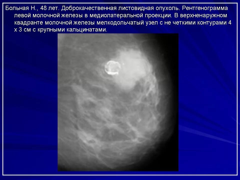 Округлые образования в молочной железе. Олеогранулемы молочной железы на УЗИ. Филлоидная (листовидная) опухоль. Галактоцеле молочной железы маммография. Филлоидная опухоль молочной.