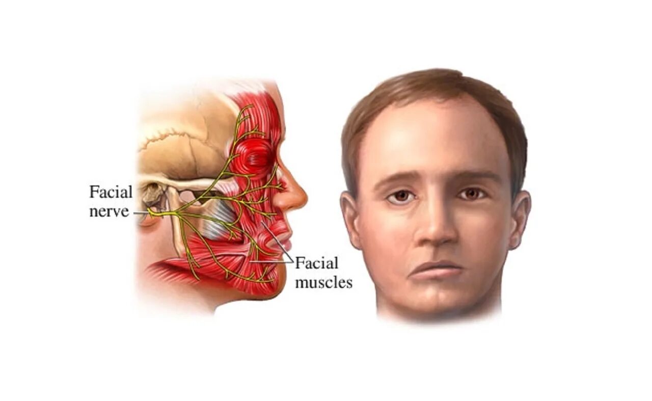 Посттравматическая нейропатия лицевого нерва. Воспаление лицевого нерва. Повреждение тройничного нерва.