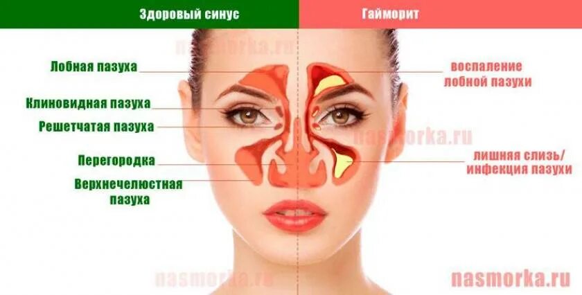 Гайморит симптомы у взрослых. Симптомы гайморита у взрослых без температуры признаки