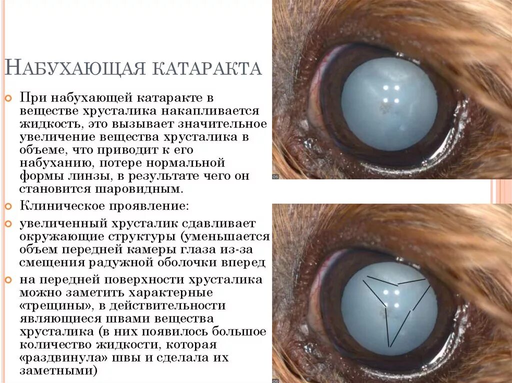 Что нельзя делать при замене хрусталика глаза. Осложнения набухающей катаракты. Незрелая возрастная катаракта осложнения. Набухающая катаракта клинические рекомендации. Катаракта помутнение хрусталика.