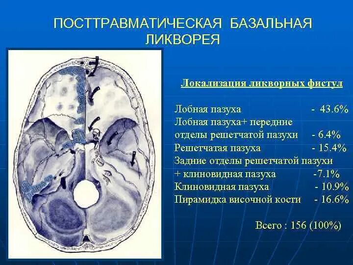 Усиленный в базальных отделах. Посттравматическая ликворея.