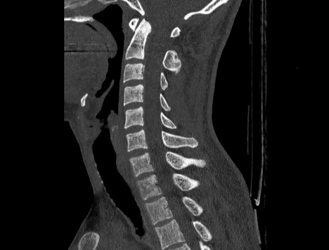 СКТ позвоночника. Спондилит позвоночника рентген. CT cervical Spine]. Компьютерная томография позвоночника.