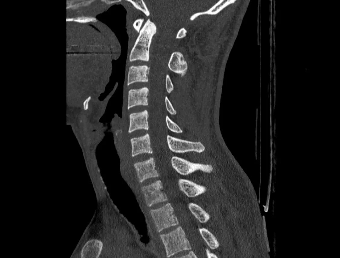 Можно делать кт позвоночника. СКТ позвоночника. Спондилит позвоночника рентген. CT cervical Spine]. Компьютерная томография позвоночника.