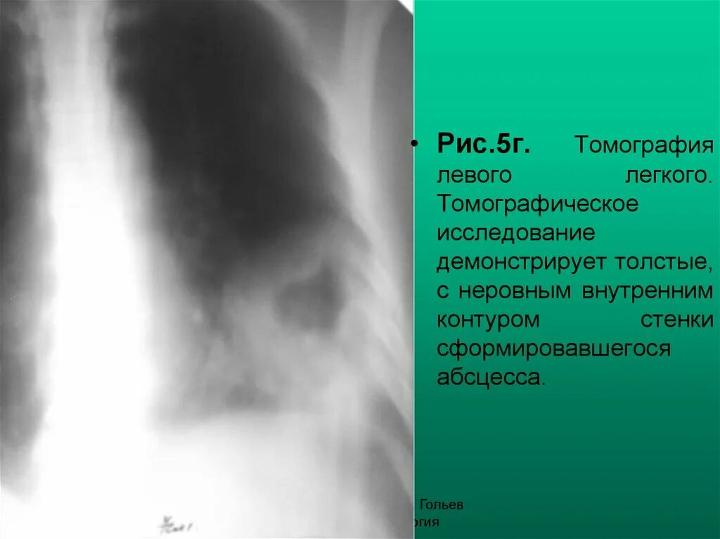 Томограмма левого легкого. Кольцевидная тень легкие. Кольцевидные тени в легких на рентгене. Кольцевидная тень на желудке. Тень в левом легком