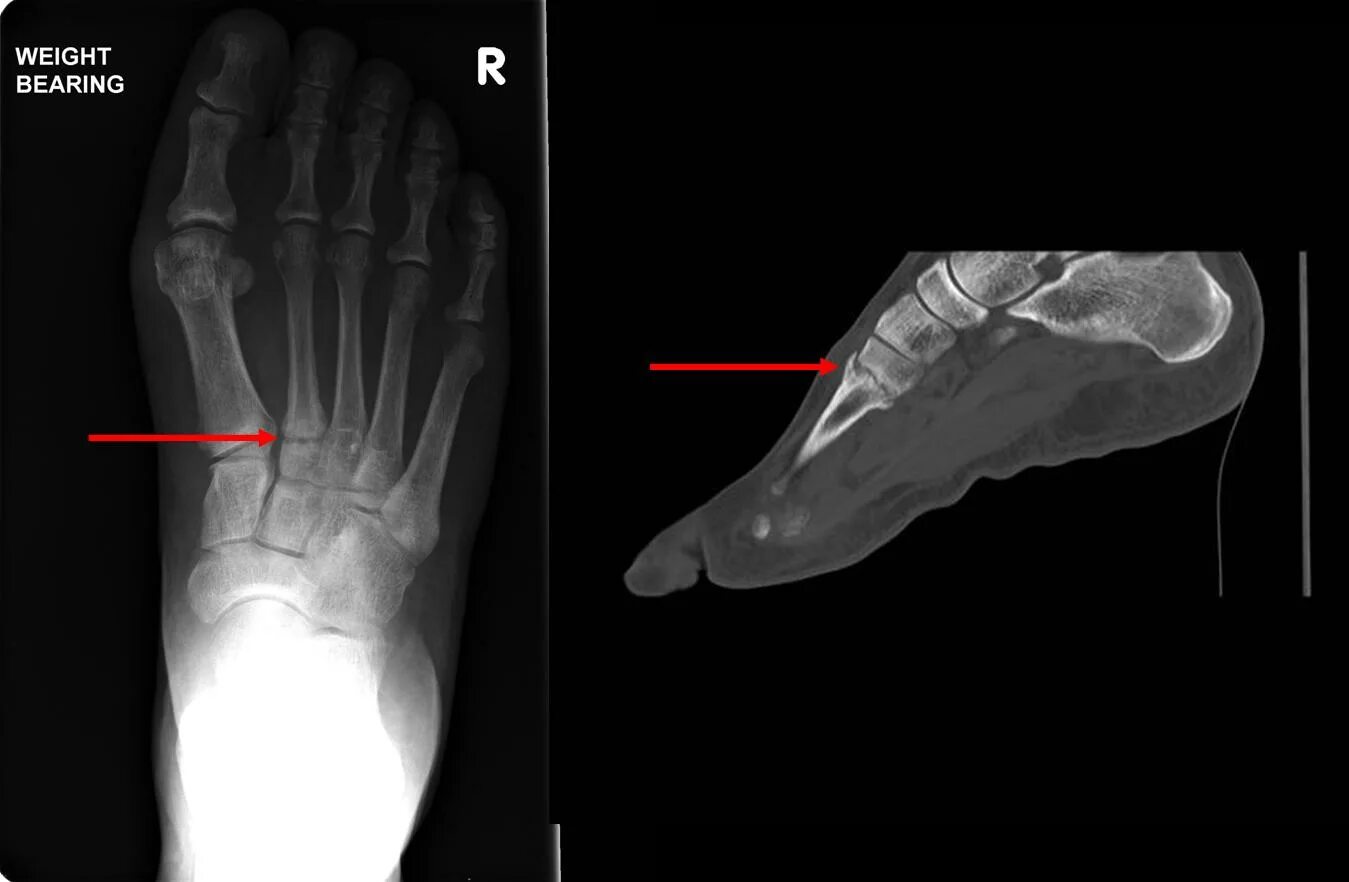 Fracture валорант. Рентген перелома ступни трещина. Перелом подошвы