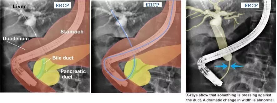 Эндоскопическое стентирование панкреатического протока. Хронический панкреатит ЭРХПГ. Стентирование протока поджелудочной железы. Стент желчного протока