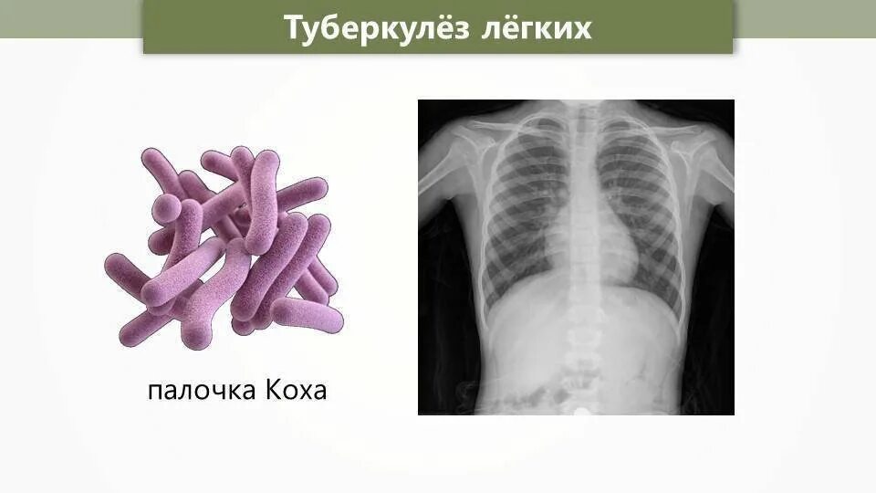 Туберкулез кокки. Палочка Коха туберкулез. Туберкулезная палочка палочка Коха. Палочка Коха форма бактерии. Микобактерия туберкулеза палочка Коха.