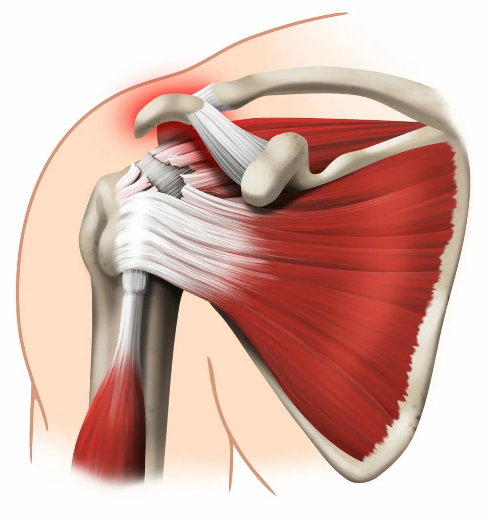Ротаторная манжета плечевого сустава сухожилия. Повреждение ротаторная манжета. Вращательная манжета плечевого сустава мышцы. Ротаторная манжета плечевого разрыв. Повреждения правого плечевого сустава