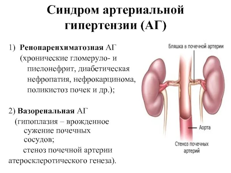 Пиелонефрит лекция. Синдром артериальной гипертензии почки. Механизм развития артериальной гипертензии при заболеваниях почек. Синдром почечной гипертонии пропедевтика. Признак почечной формы гипертонической болезни.