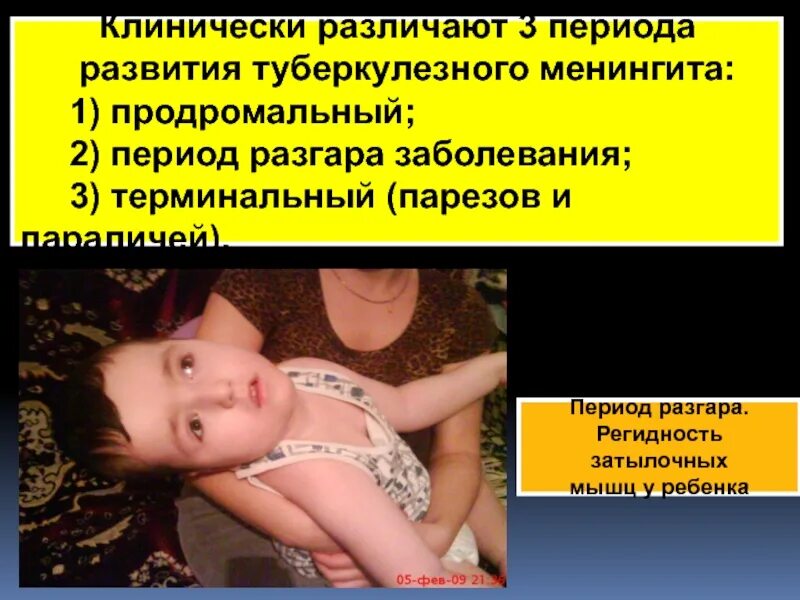 Туберкулезный менингит проявления. Периоды туберкулезного менингита. Периоды клинического течения туберкулезного менингита. Менингококковая инфекция формулировка диагноза. Туберкулезный менингит проявления.