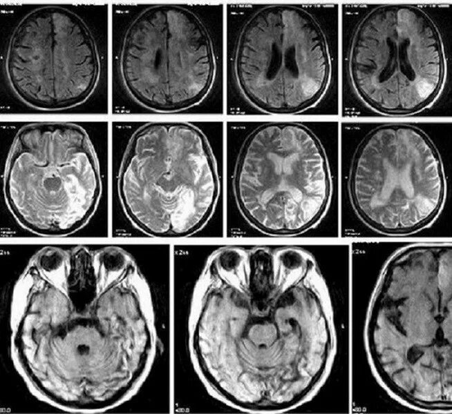 Многоочаговые поражения головного. Ишемический инсульт снимок кт. Ишемический инсульт мрт. Ишемический инсульт кт и мрт. Мрт головного мозга инсульт.
