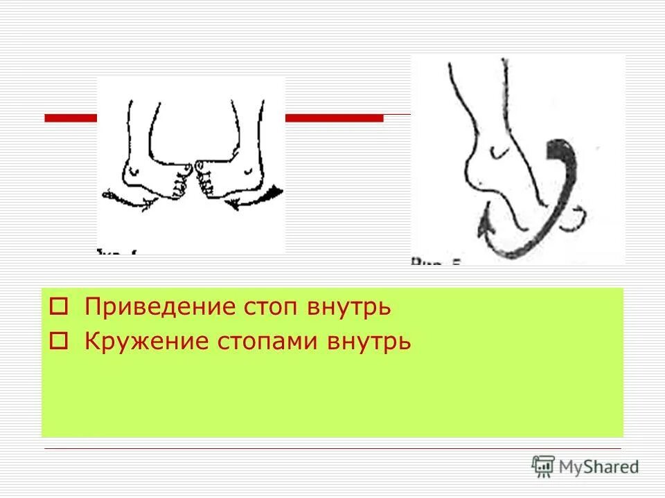 приведение переднего отдела стопы. приведение стопы у ребенка. приведение переднего отдела стопы у детей. приведение стопы у ребенка. приведение стопы у ребенка.
