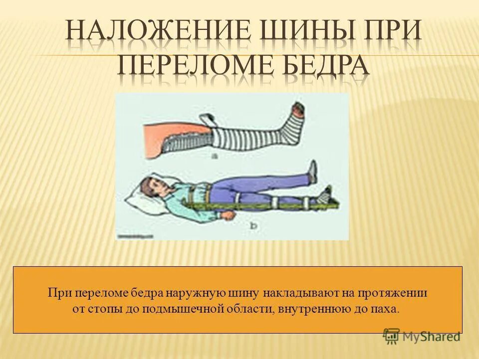 Наложение шины при переломе. Наложение шины при переломе