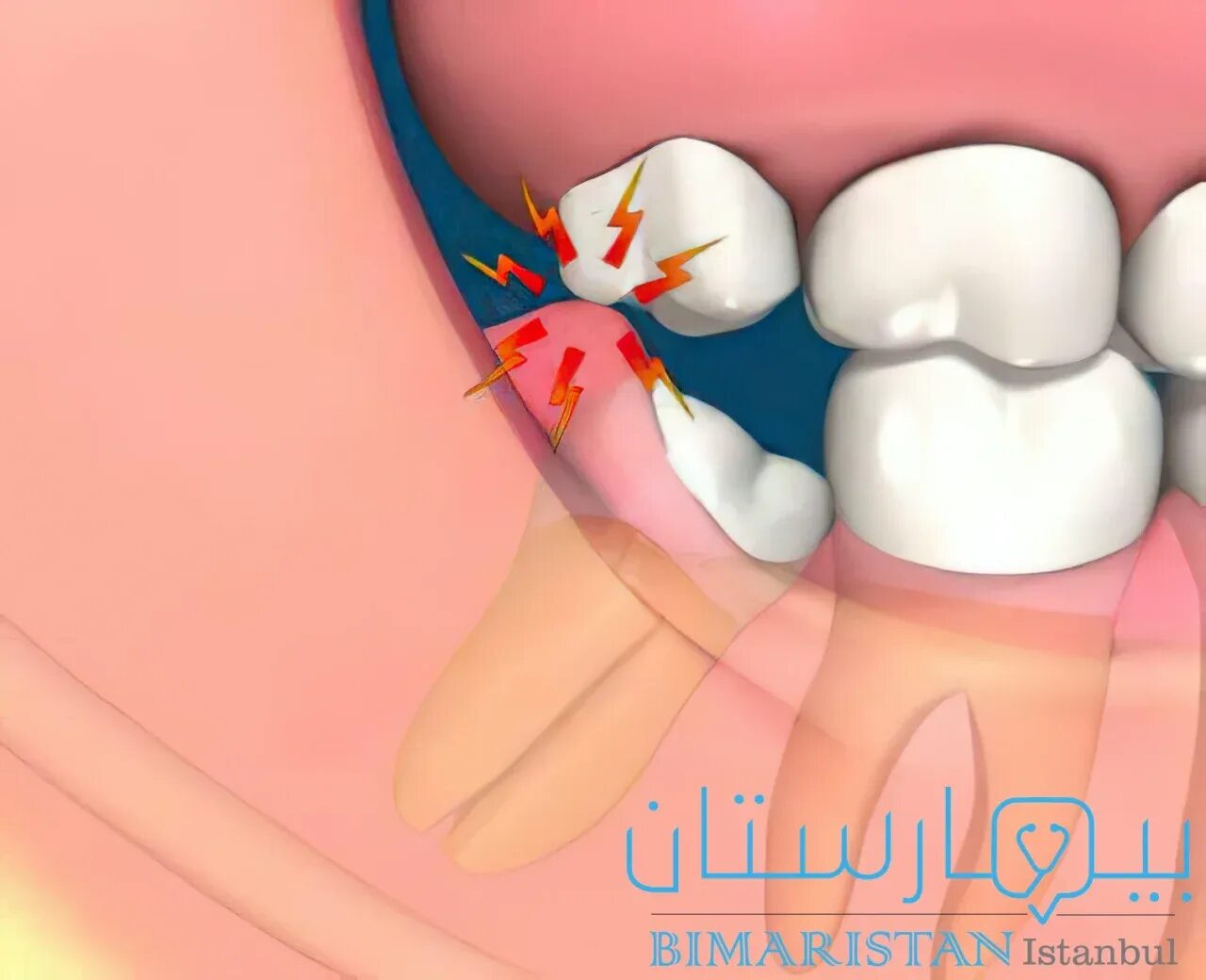 Капюшон десны на зубе мудрости. Капюшон восьмерки. Перикоронарит воспаление. Гнойный перикоронарит. Перикоронарит зуба мудрости.