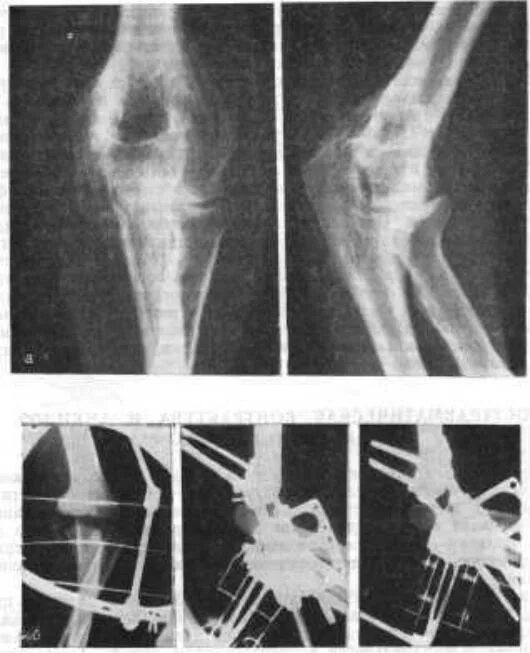 Контрактура сустава после перелома. Анкилоз сустава рентген. Анкилоз локтевого сустава. Контрактура Фолькмана рентген. Что такое анкилоза сустава и контрактура.