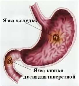 Перфорация язвы желудка и двенадцатиперстной кишки проявляется. Перфорация язвы желудка и двенадцатиперстной кишки проявляется