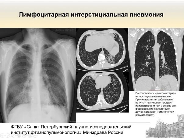 Пневмония ноябрь 2025. Лимфоидная интерстициальная пневмония кт. интерстициальная пневмония рентген. лимфоцитарная интерстициальная пневмония кт. интерстициальные заболевания легких рентген.