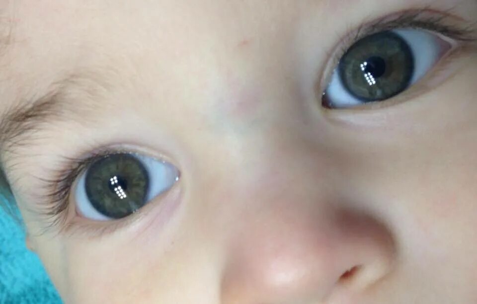 Почему у новорожденного глазки. Брушфильда пятна брушфильда. Гетерохромия у новорожденных. Глаза новорожденного. Серо голубые глаза у младенца.