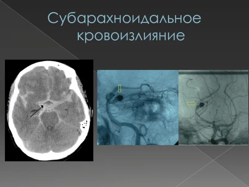 Субарахноидальное инсульт. Геморрагический инсульт субарахноидальное кровоизлияние кт. Субарахноидальный инсульт кт. Спонтанное аневризматическое субарахноидальное кровоизлияние. Травматическое кровоизлияние