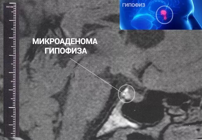 Микроаденомы гипофиза. 4мм микроаденома. Микроаденома гипофиза головного мозга у женщин что это. Пролактин микроаденома