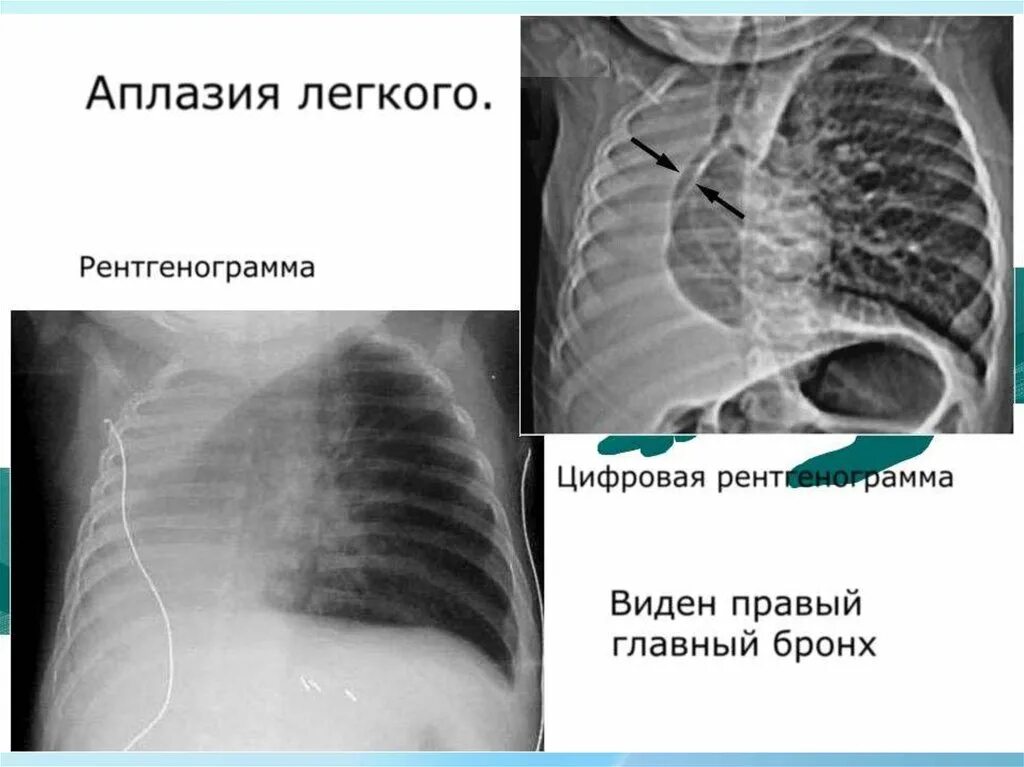 Аплазия. Аплазия. Агенезия аплазия гипоплазия почек. Односторонняя аплазия (агенезия) почки. Аплазия.