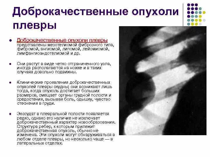 Рентгенологические признаки мезотелиомы плевры. Доброкачественные образования плевры. Злокачественные опухоли плевры рентген. Образование плевры рентген. Опухоль подвижна