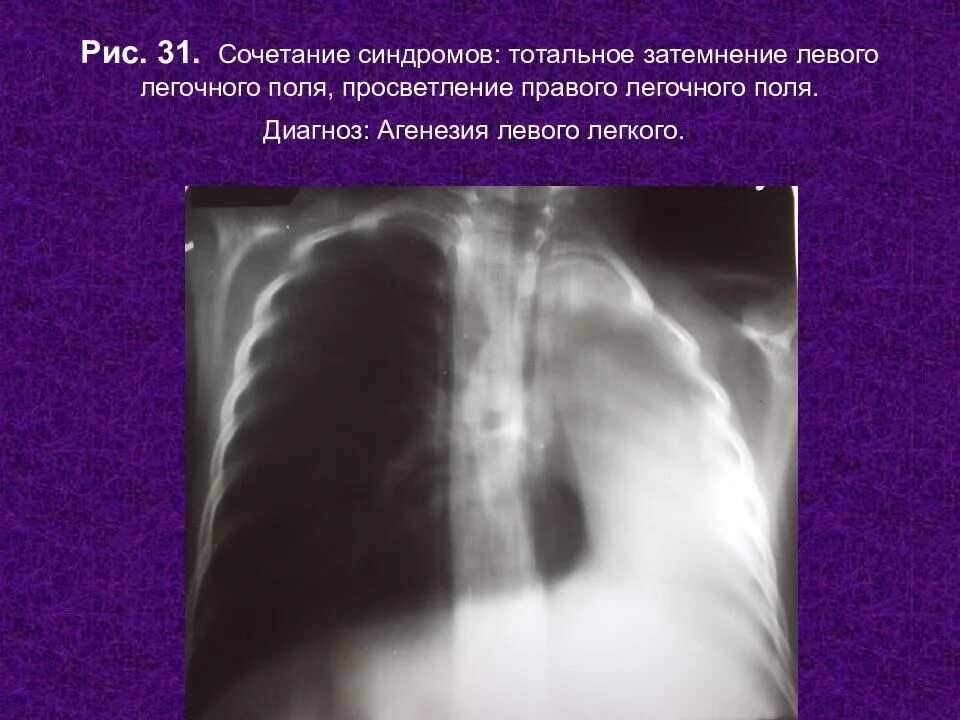 Онкология легких на рентгене. Снимок легких с левым затемнением. Затемнения лёгких на рентгене легких. Субтотальное затемнение. Образования в легких на рентгене.