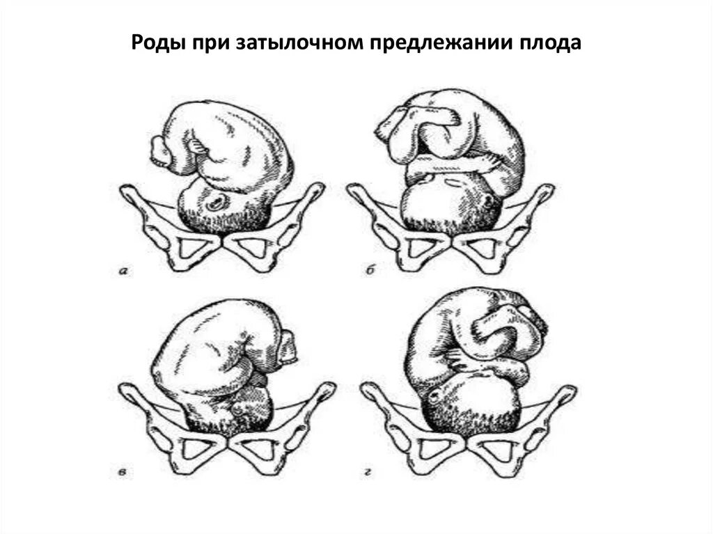 Предлежание плода 2. Головное предлежание плода 2 позиция передний вид. Предлежание плода позиция 1 передний вид. Затылочное предлежание передний вид 2 позиция. 1 Позиция передний вид затылочного предлежания.