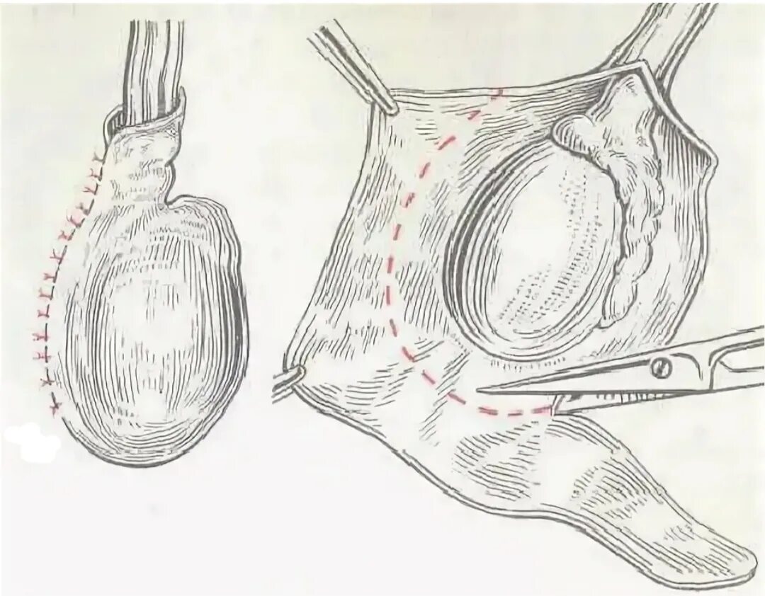 Водянка оболочек яичка операция Винкельмана. Операция Винкельмана Бергмана. Операция вилькедьмана. Операция Винкельмана и Бергмана при водянке яичка.