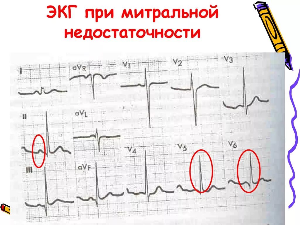 Показывает ли экг сердечную недостаточность. Митральная недостаточность экг. недостаточность митрального клапана экг. экг при пороках митрального клапана. недостаточность митрального клапана экг признаки.