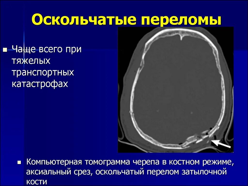 Перелом кости свода черепа. Перелом костей свода черепа кт. ЧМТ перелом свода черепа. Оскольчатые переломы черепа. Оскольчатый перелом основания черепа.