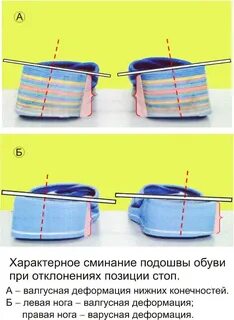 При длительном использовании подошва обуви изнашивается