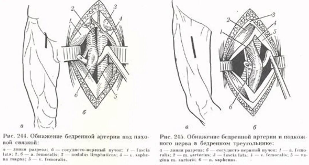 Бедренная перевязка. Перевязка бедренной артерии. Проекция перевязки бедренной артерии. Проекционные линии сосудисто нервных Пучков КРС. Линия проекции бедренной артерии по Пирогову.