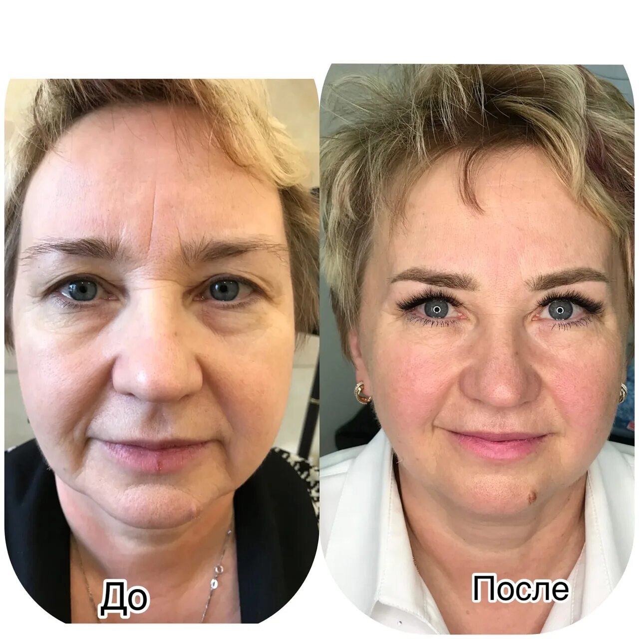 Блефаропластика plasma liner. Холодная плазма в косметологии. Веки до и после холодной плазмы в косметологии. Холодная плазма для лица после процедуры. Холодная плазма в косметологии.