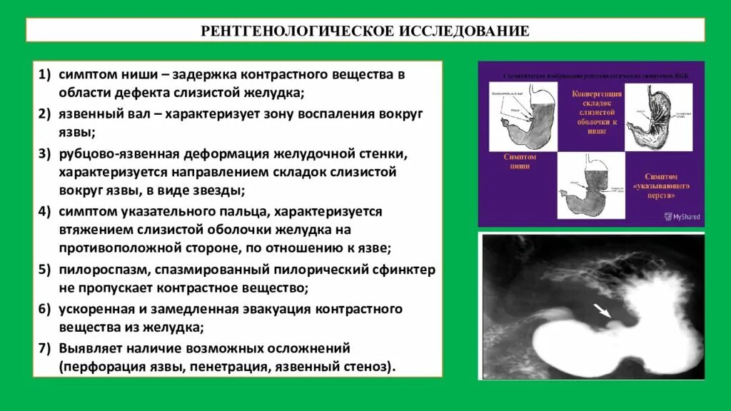 Симптом и синдром болезни. Рентгенологический симптом ниши. рентгеноконтрастное исследование желудка. рентгенконтрастное исследование с ва желуда.