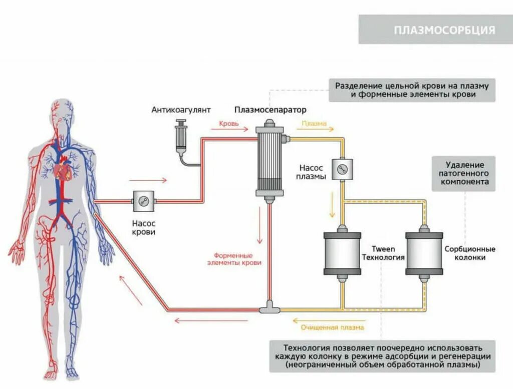 Плазмоферез что это. Аппарат для фильтрации крови. Селективная плазмофильтрация Evaclio. Плазмаферез и плазмосорбция разница. Плазмосорбция крови.