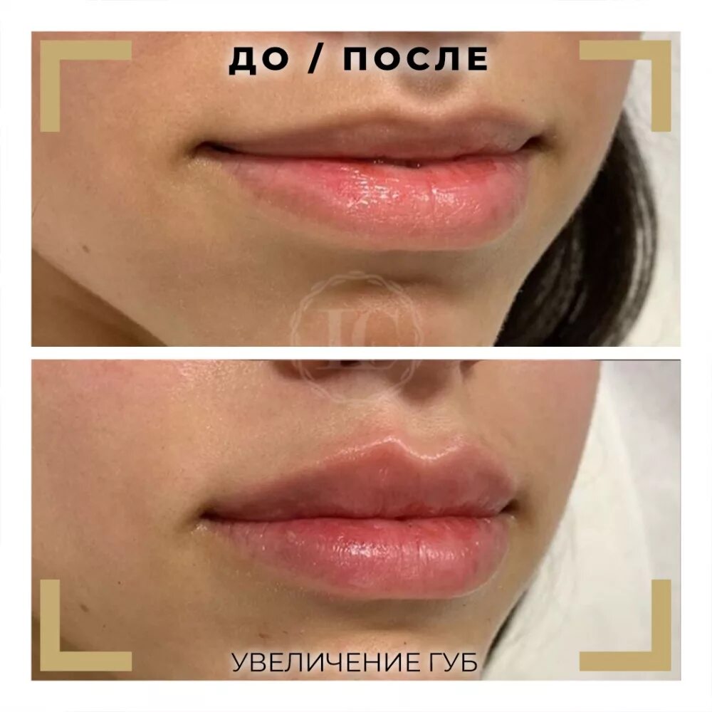 Через сколько разминать губы. Формы губ. губы гиалуроновой кислотой.