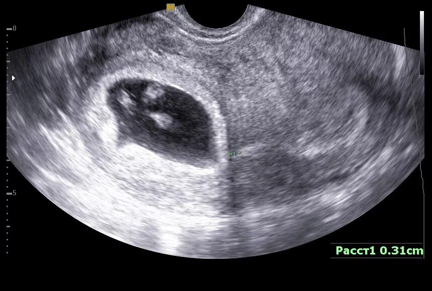 Разрыв плодных. УЗИ беременность 2 плодных яйца. Внематочная беременность 6 недель УЗИ. Плодное яйцо на УЗИ В матке 6 недель. Плодное яйцо на УЗИ 3 недели.
