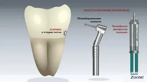 Стадии лечения кариеса