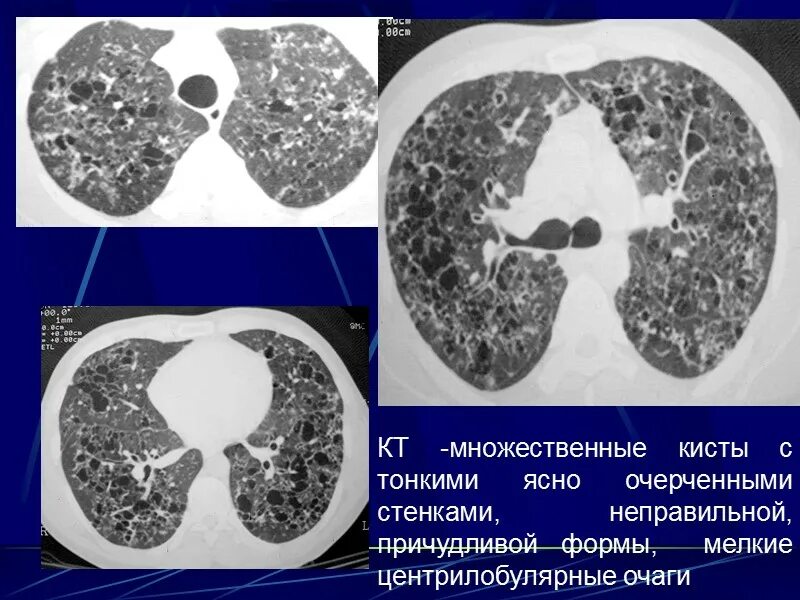 Панлобулярная эмфизема на кт. Центрилобулярная эмфизема. Парасептальная эмфизема легких на кт. Фиброзирующий альвеолит на кт. Диффузные изменения в легких