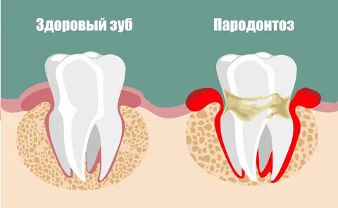 Парадонтозные зубы