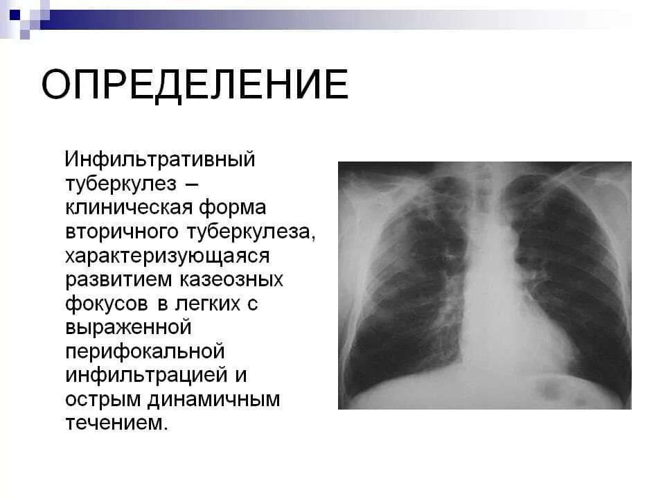 Начальная стадия туберкулеза у взрослых. Легочная форма туберкулеза симптомы. Туберкулез клиническая картина периоды. Закрытая форма туберкулеза. Туберкулёз открытой формы симптомы.