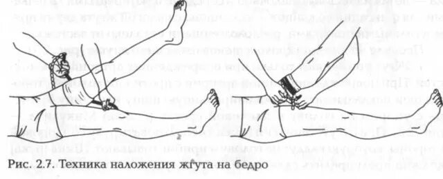 Технику наложения жгута на конечности. Наложение кровоостанавливающего жгута на бедро.