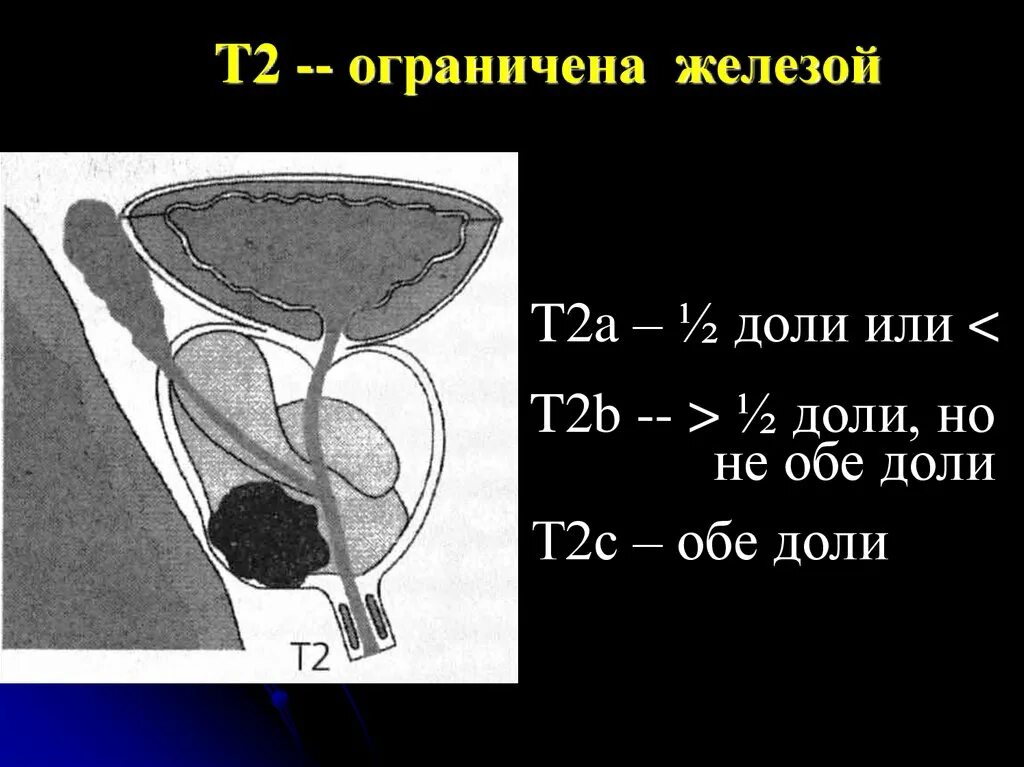 Т простаты