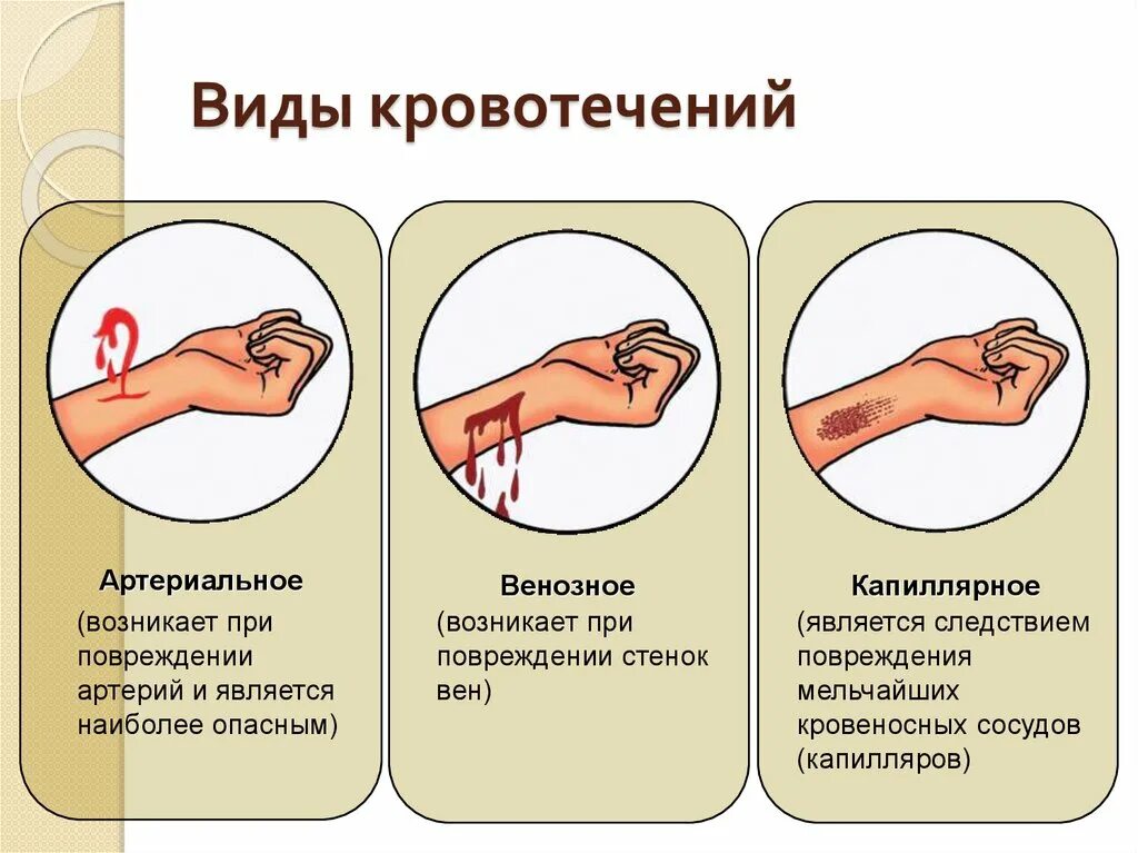 Почему может быть кровотечение. Типы кровотечений в зависимости от типа поврежденного сосуда. Виды кровотечений по виду поврежденного сосуда. Типы крови венозная и артериальная капиллярная.